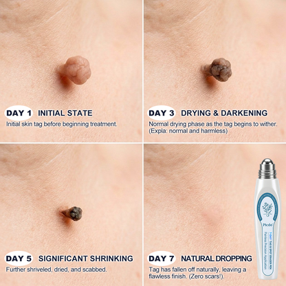 𝐎𝐟𝐟𝐢𝐜𝐢𝐚𝐥 𝐁𝐫𝐚𝐧𝐝 𝐒𝐭𝐨𝐫𝐞 |🧿𝐏i𝐜𝐝o® 7-𝐷𝑎𝑦 𝗧𝐚𝐠 & 𝗦𝗽𝐨𝐭 𝐄𝐫𝒂𝒔𝒆𝒓(Zero Pain, Zero 𝐒𝐜𝐚𝒓𝒔 Rollerball)💦